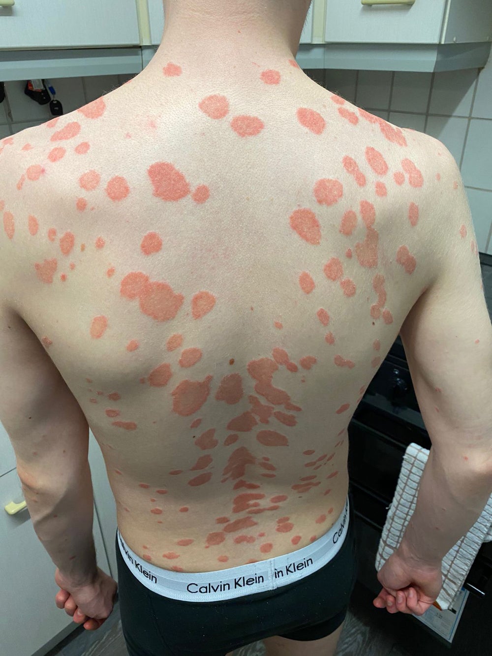 The psoriasis at its worst on Scot Cunningham’s back (Collect/PA Real Life)