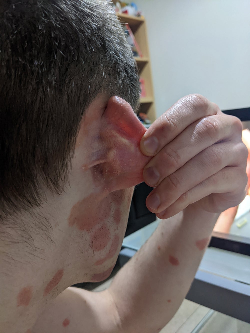 Scot Cunningham, 27, with psoriasis around his ear (Collect/PA Real Life)