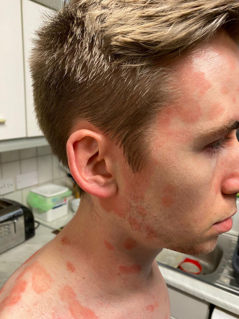 Scot Cunningham, 27, lost all confidence when the psoriasis spread to his face (Collect/PA Real Life)