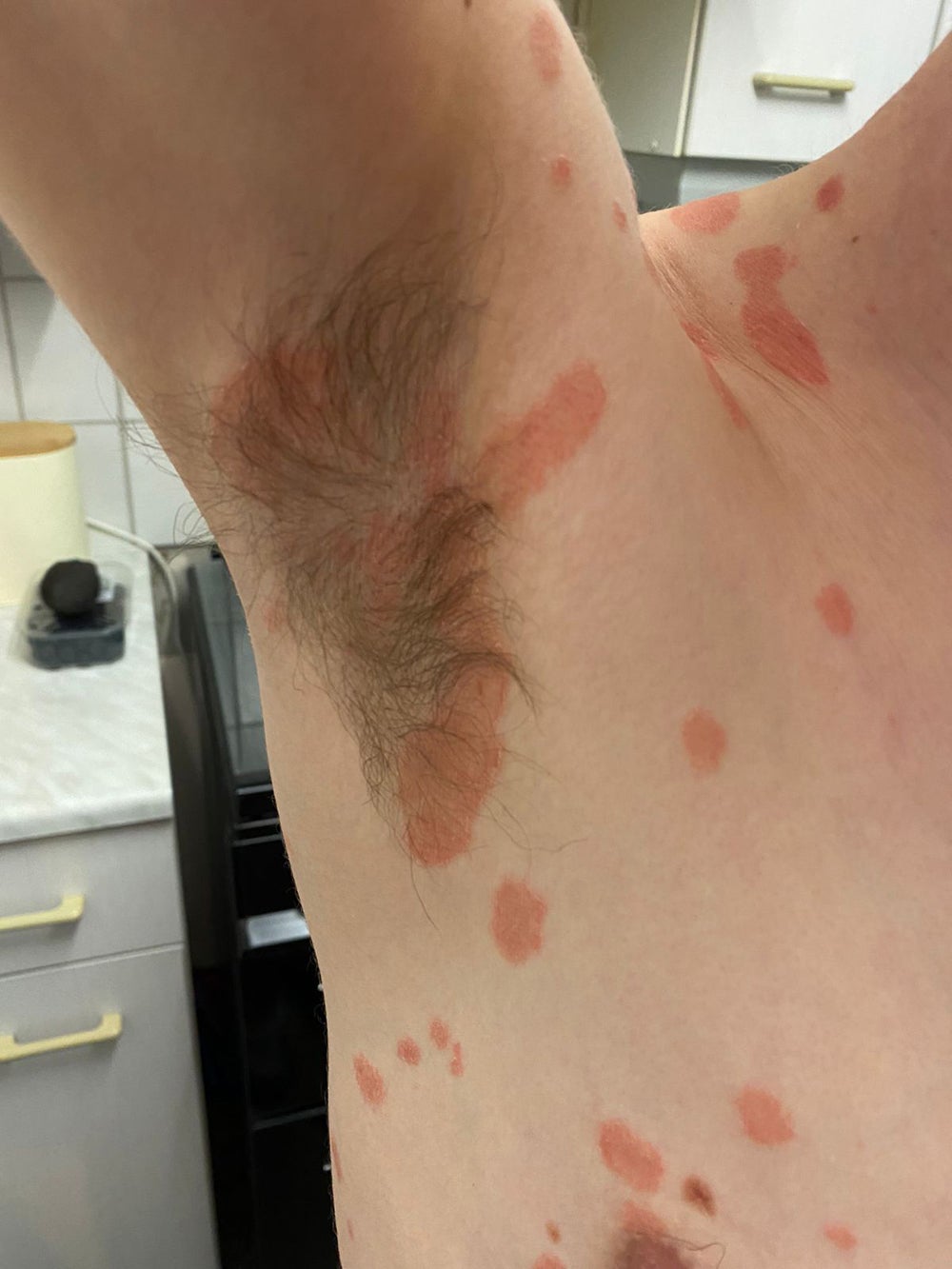 Psoriasis on Scot’s underarm (Collect/PA Real Life)