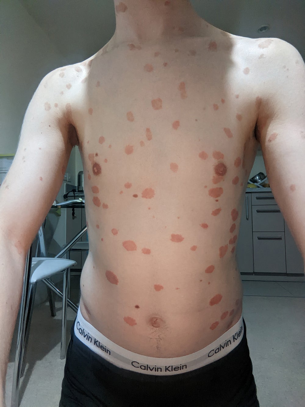 Scot Cunningham, 27, had psoriasis covering his whole body (Collect/PA Real Life)