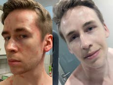 Man credits diet change and £19.99 skin cream for treating his psoriasis  