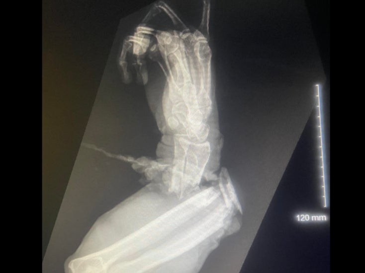 An X-ray image shared by Florida Gator Gardens shows the extent of damage a wildlife expert suffered after being attacked by an alligator