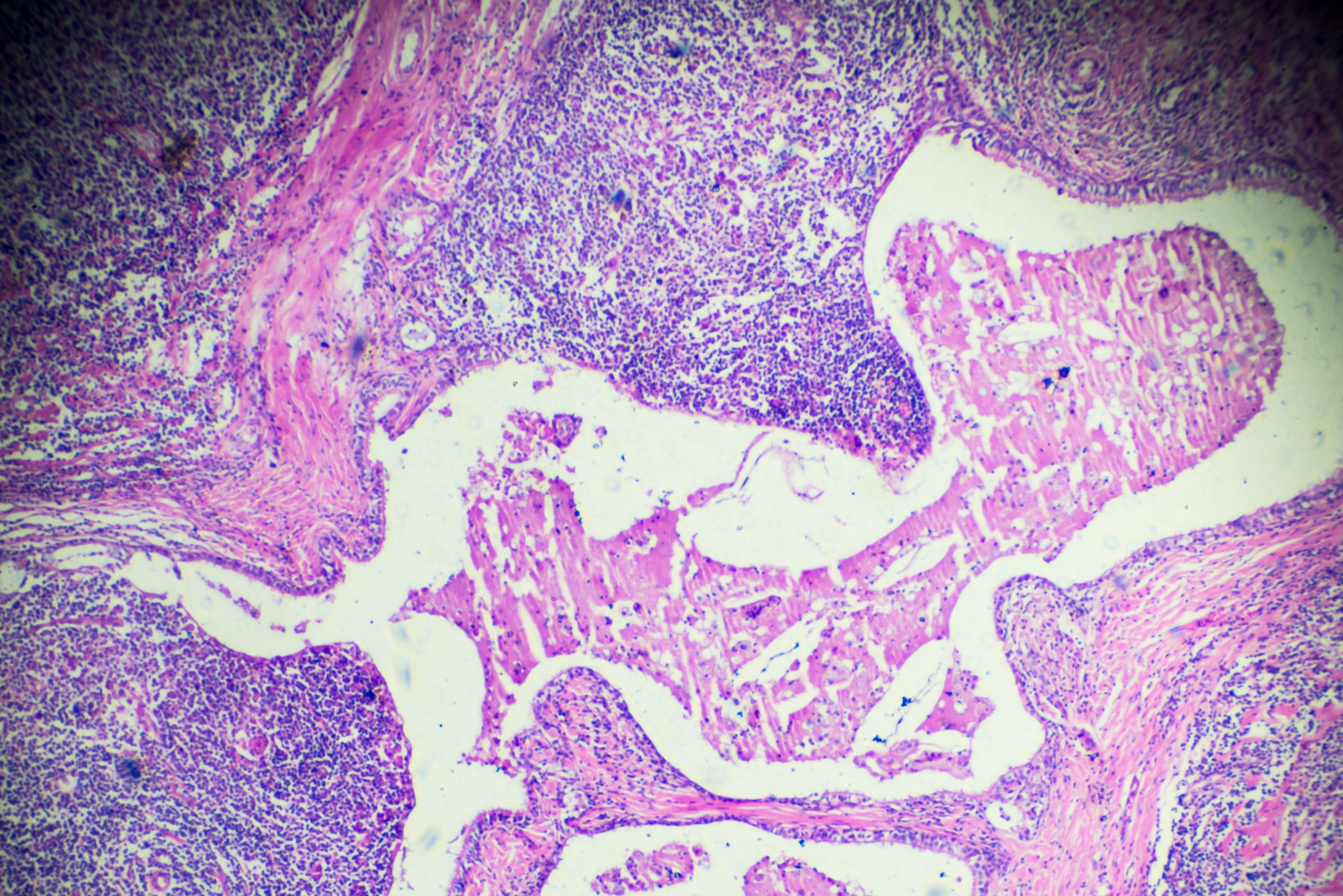 Hodgkins lymphoma cells under a microscope