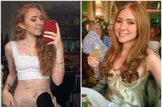 Woman who got a stoma bag at 25 says it has given her back her life