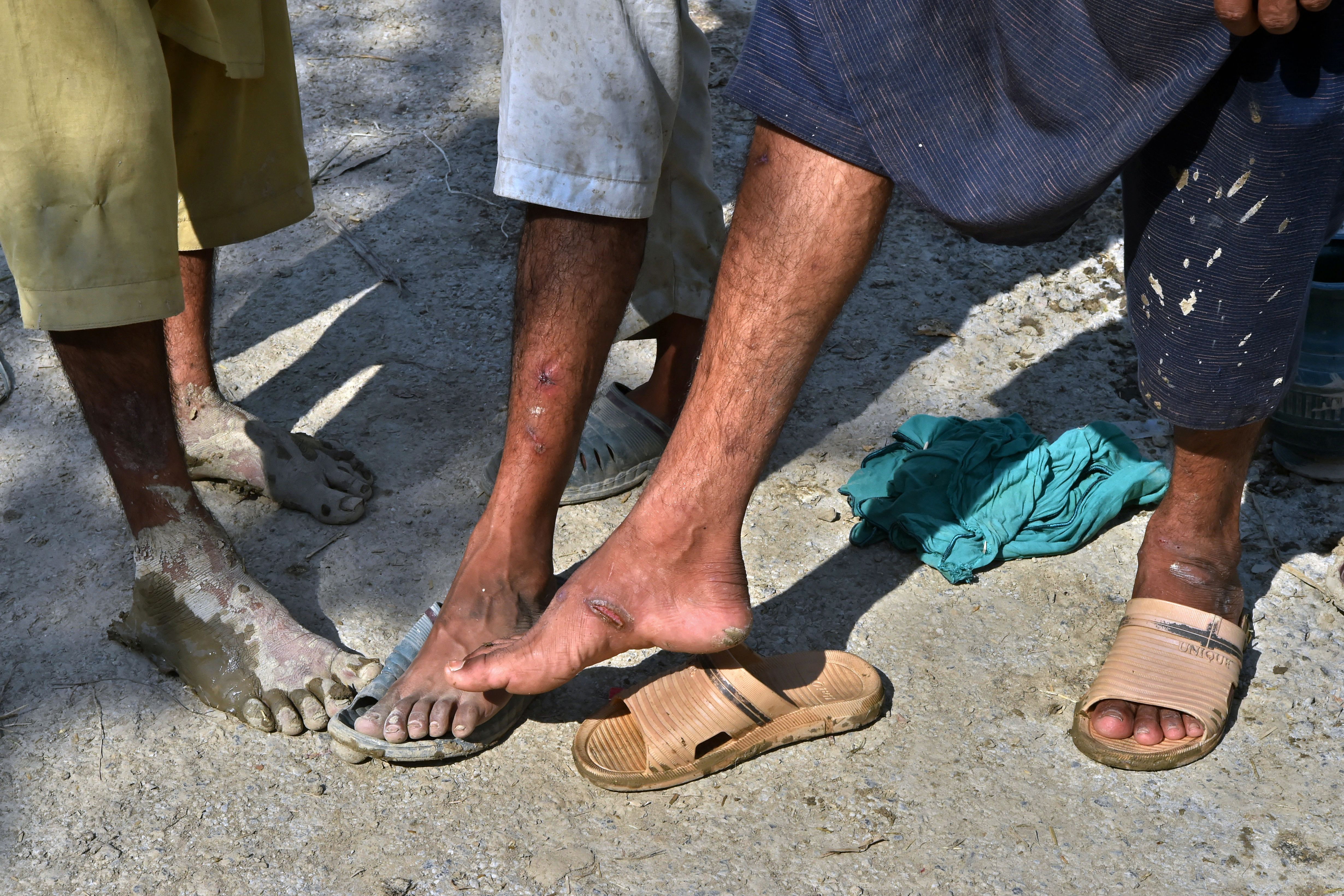 Flood-affected people show their infected legs at Jindi village in the Charsadda district of Khyber Pakhtunkhwa
