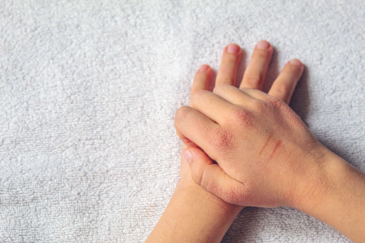 New drug therapy &lsquo;highly effective&rsquo; for young children with severe eczema