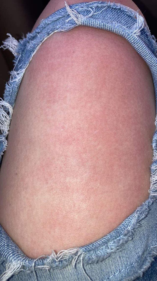 Aquagenic Urticaria Teen Suddenly Develops Allergy To Water The