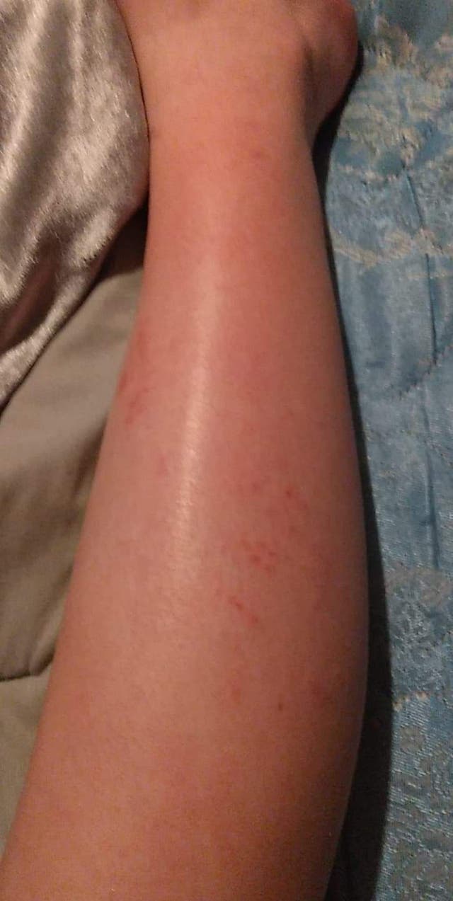 Water Rashes Aquagenic urticaria: Teen suddenly develops allergy to water | The ...