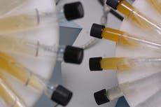 Not enough people offered kidney disease test, research finds