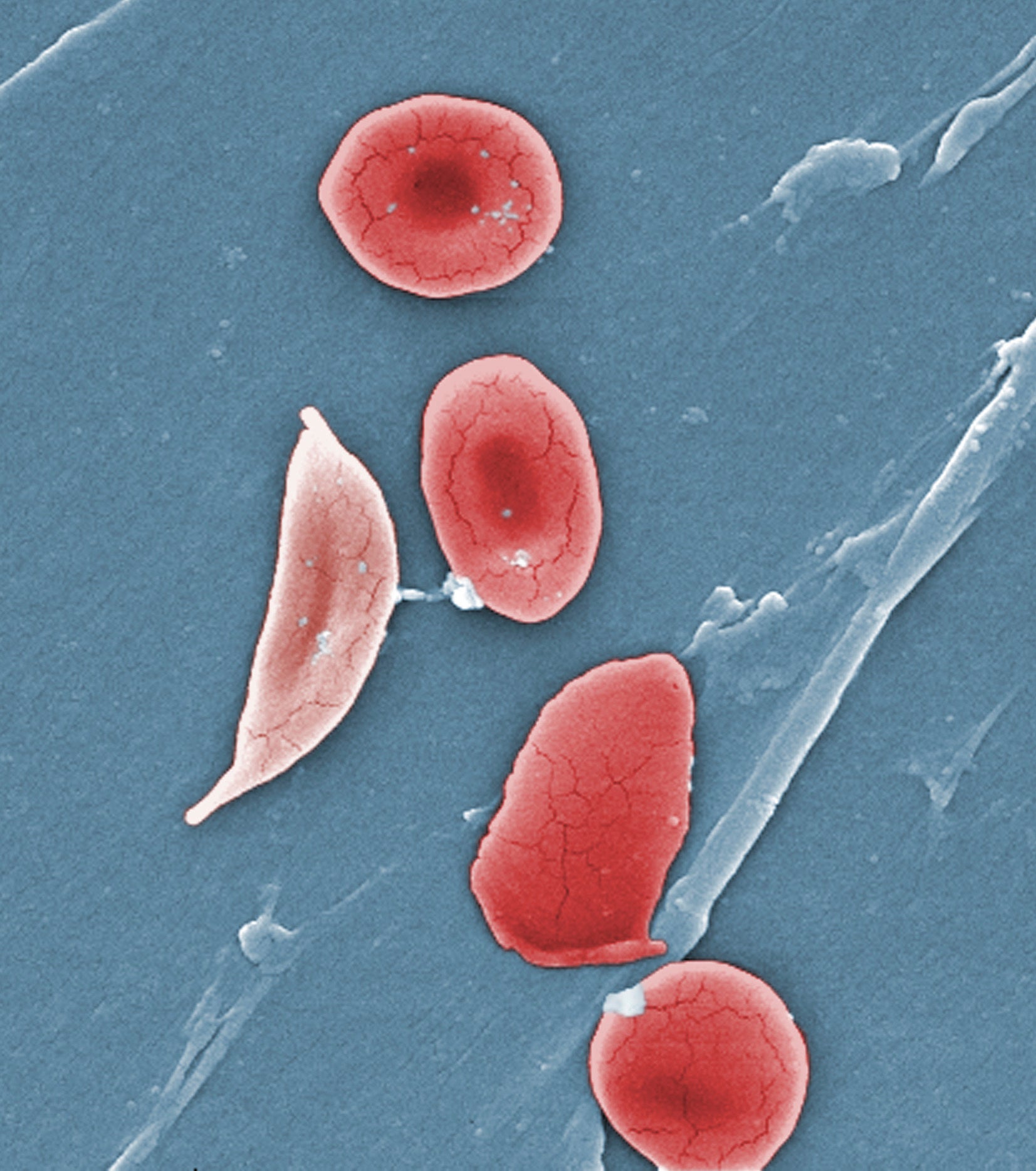 Sickle Cell Disease