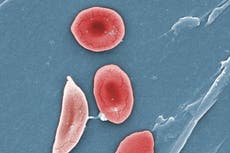 Study: Too few kids with sickle cell get stroke screen, care