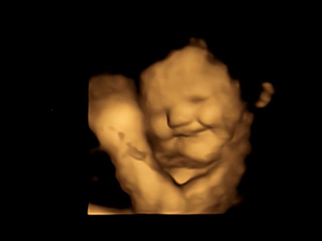 <p>A 4D ultrasound image of a baby reacting to the flavour of carrots</p>