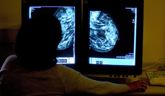 Researchers have called for breast cancer surgery guidelines to be revised (PA)