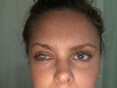 Woman left in ‘excruciating pain’ and partially blind due to dirty makeup bag