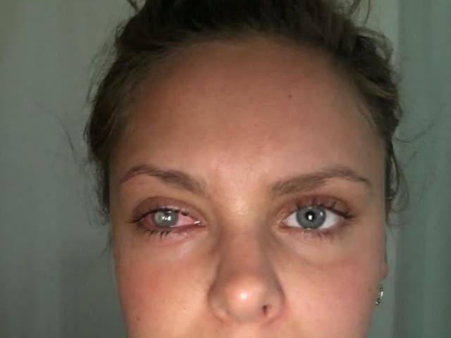 <p>Laura Hawkins with her infected eye</p>