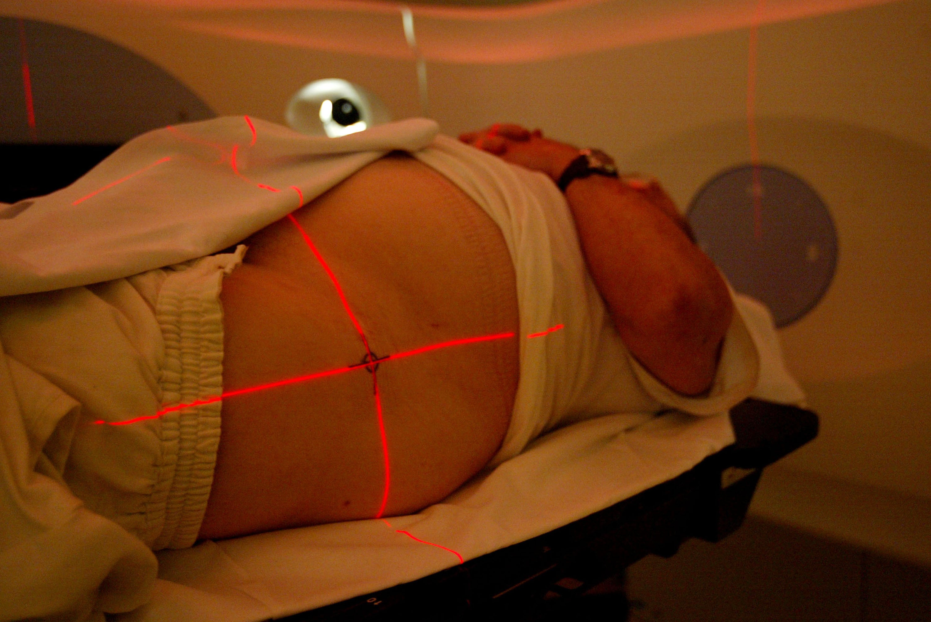 Lasers are pinpointed on a patient with prostate cancer at the radiation oncology centre at Cape Fear Valley Medical Centre in Fayetteville, North Carolina