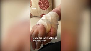 Man's hand saved by surgeons who stitched it to his chest