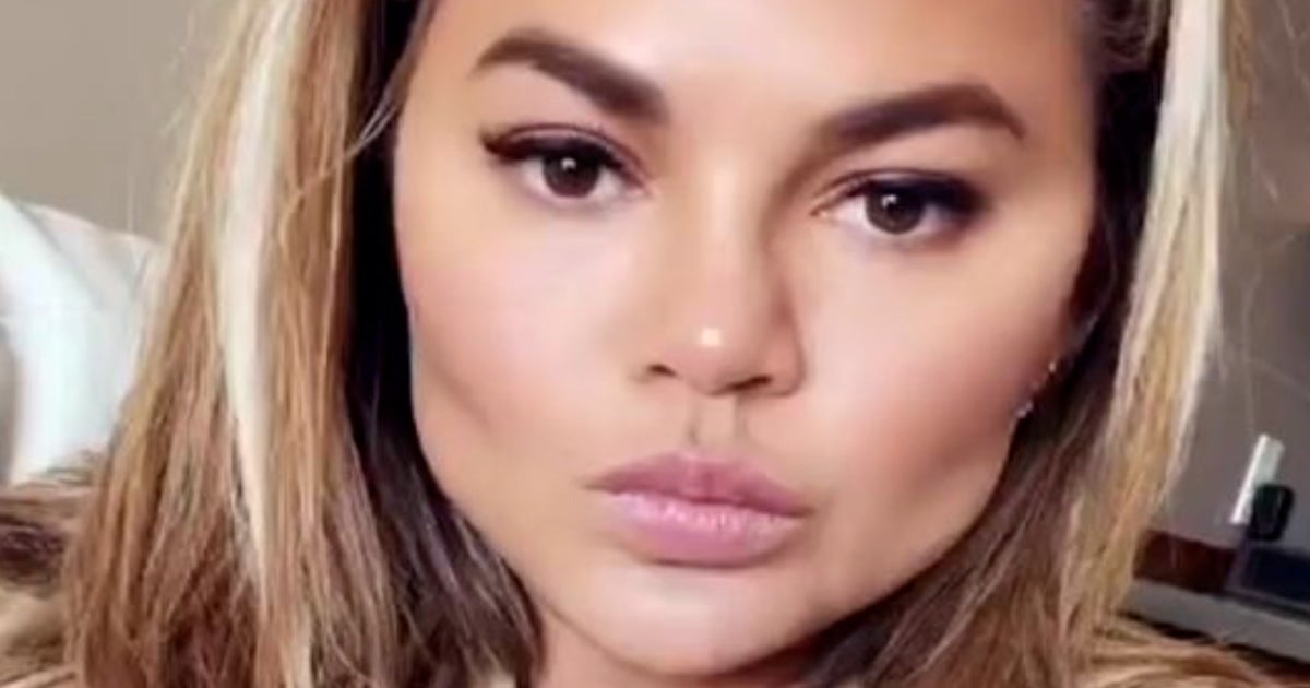 Chrissy Teigen Reveals Results of 'Fat Removal' Face Surgery: Photo