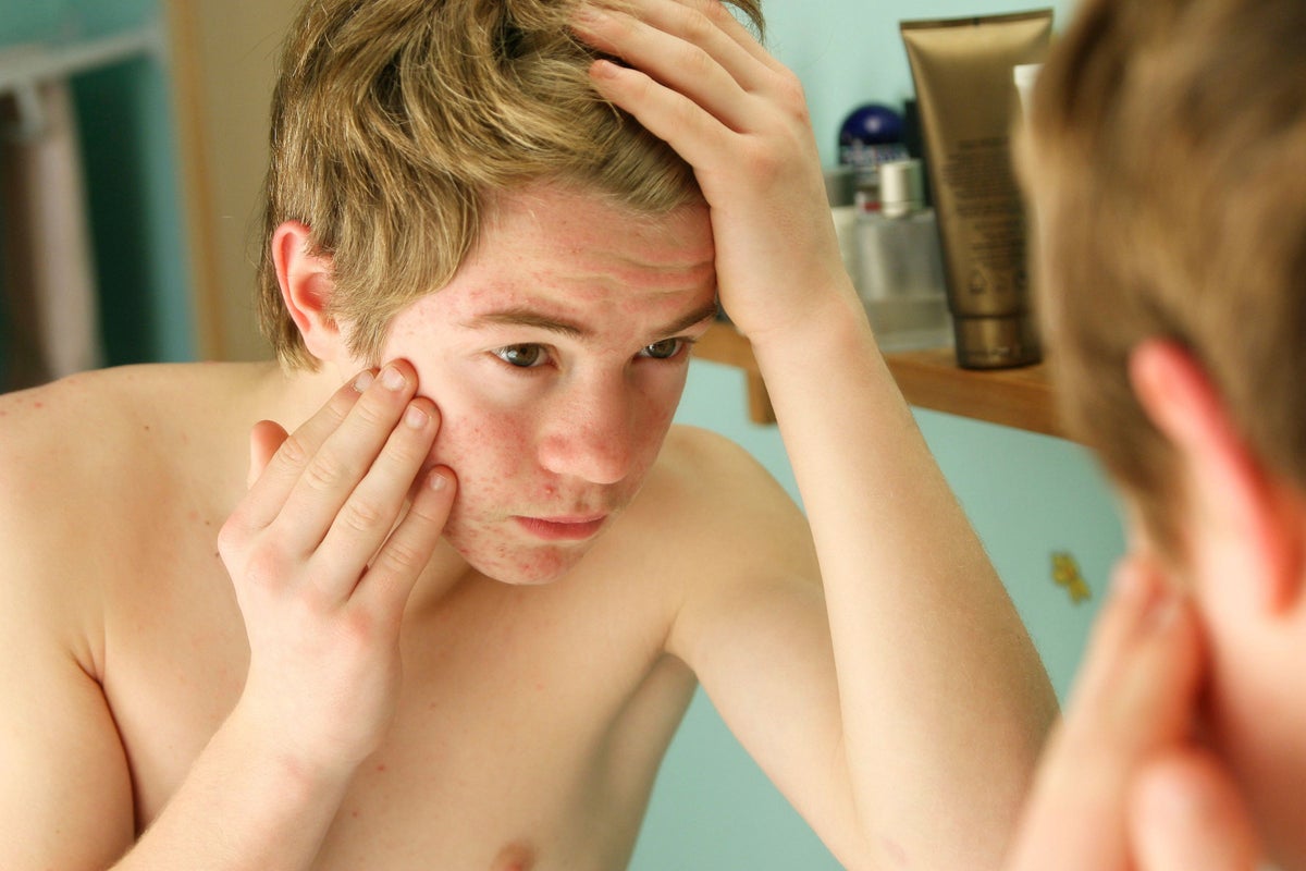Acne treatment: How to support a teenager who has acne | The Independent - Fast Acne Treatment Methods For Teens