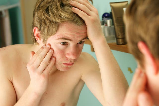Acne is very common during puberty (Alamy/PA)