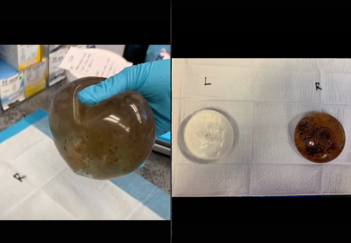 Woman shares photo of ‘mouldy’ breast implant that led to autoimmune disorder Woman shares photo of ‘mouldy’ breast implant that led to autoimmune disorder