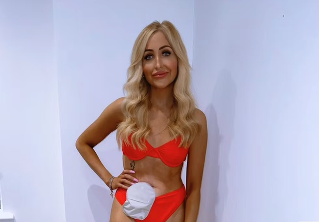<p>Holly proudly showing off her stoma in a bikini </p>
