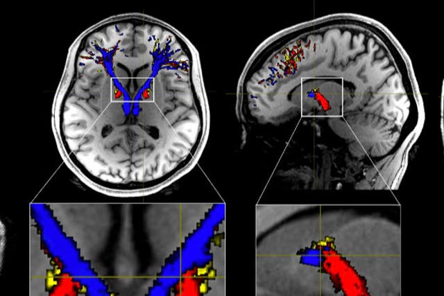 <p>Addicts’ brains contain less white matter than people who do not consume the class A substances, say experts</p>