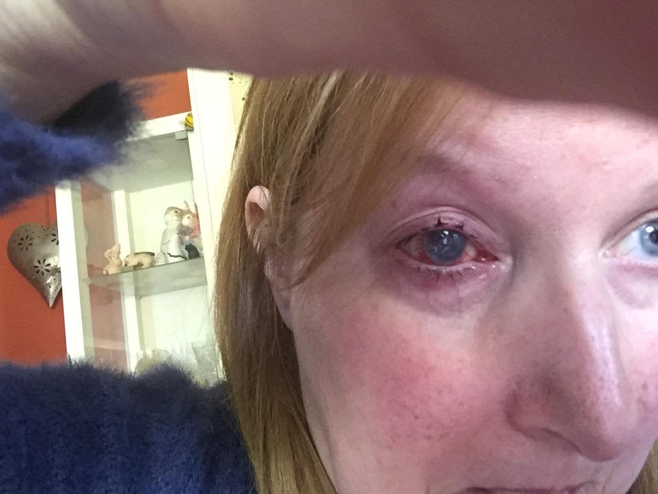 Marie Mason's eye three years after being diagnosed