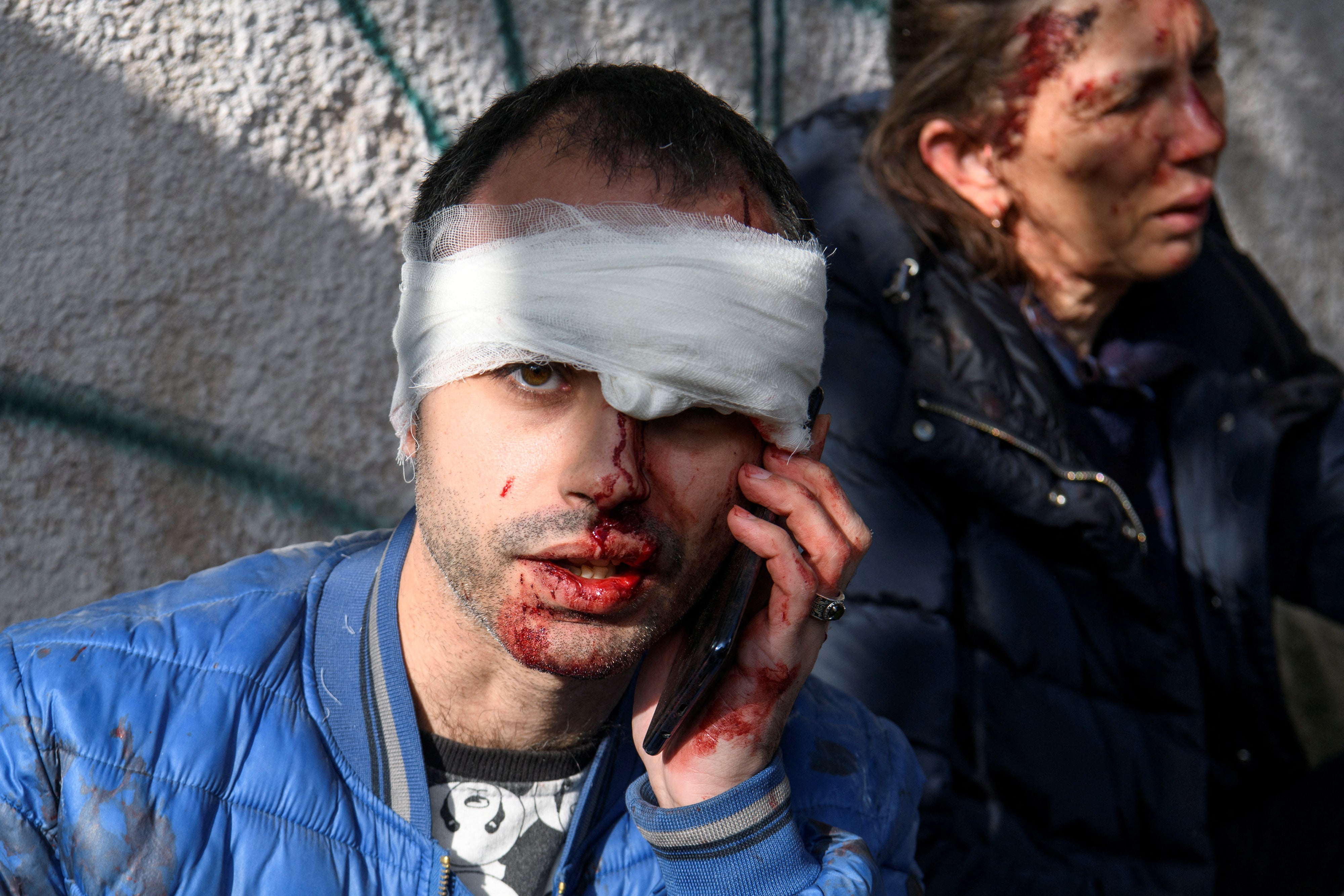 An injured man speaks on his mobile phone at a site of a Russian missile strike in Kyiv