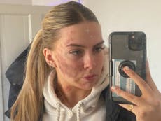 Woman with mystery rash on her face says doctors can’t diagnose her