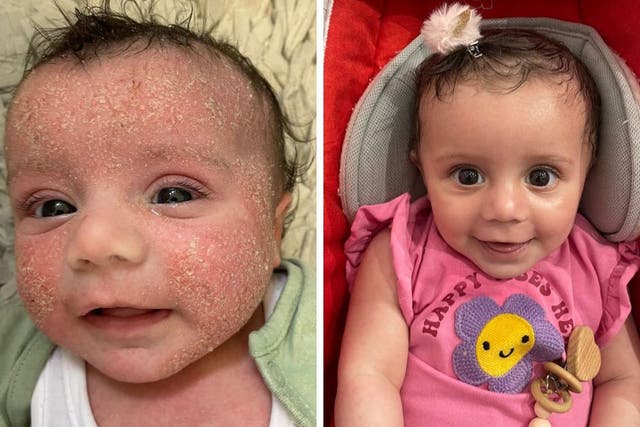 Nola’s skin before and after (Collect/PA Real Life)