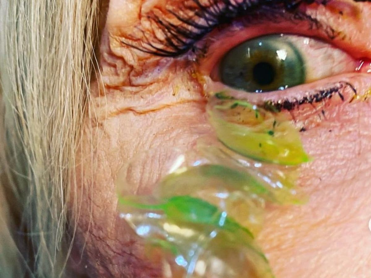 Ein Arzt veröffentlichte ein Video, in dem er 23 Kontaktlinsen aus dem Auge eines Patienten entfernt, der es vergessen hat
