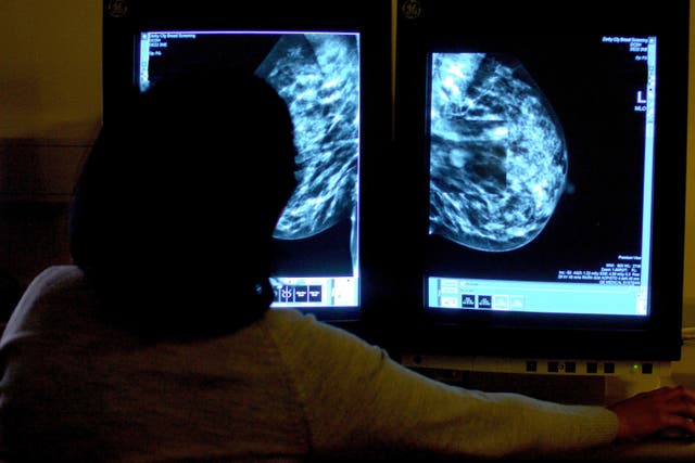Two in five women waiting for breast reconstruction during the pandemic faced a delay of two years or more, according to a poll (PA)