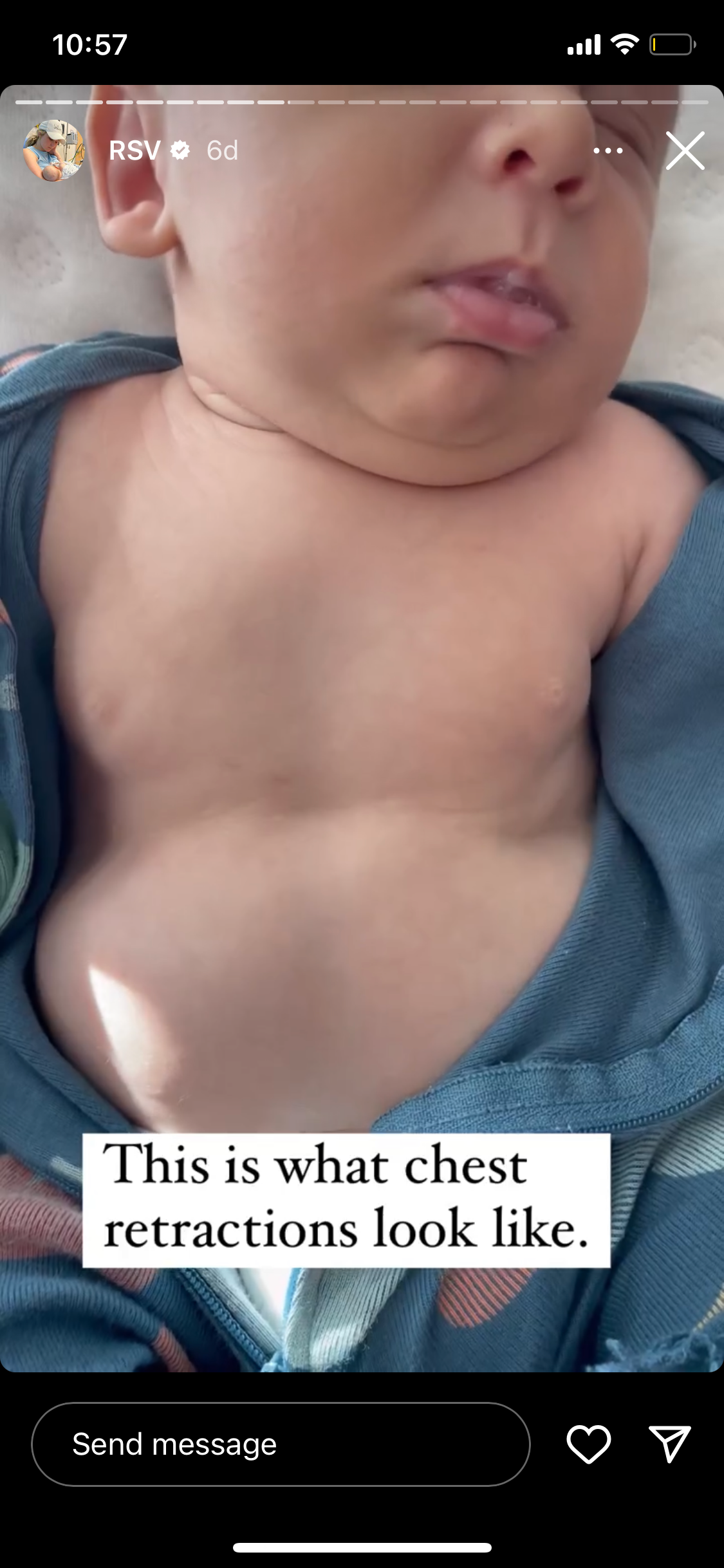 Mother of six shared video of her son experiencing chest retractions