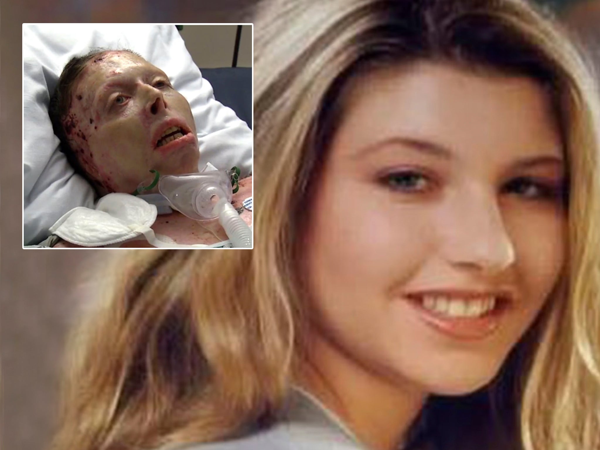 Young Woman Survives Severe Burns On After Fiery Car Crash