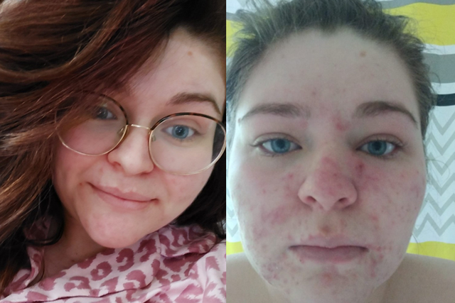 Esme has struggled with acne since her first pregnancy in 2017 (Collect/PA Real Life)