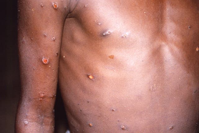 Transmission of the monkeypox virus occurs up to four days before any symptoms appear, scientists have discovered (Brian WJ Mahy/PA)
