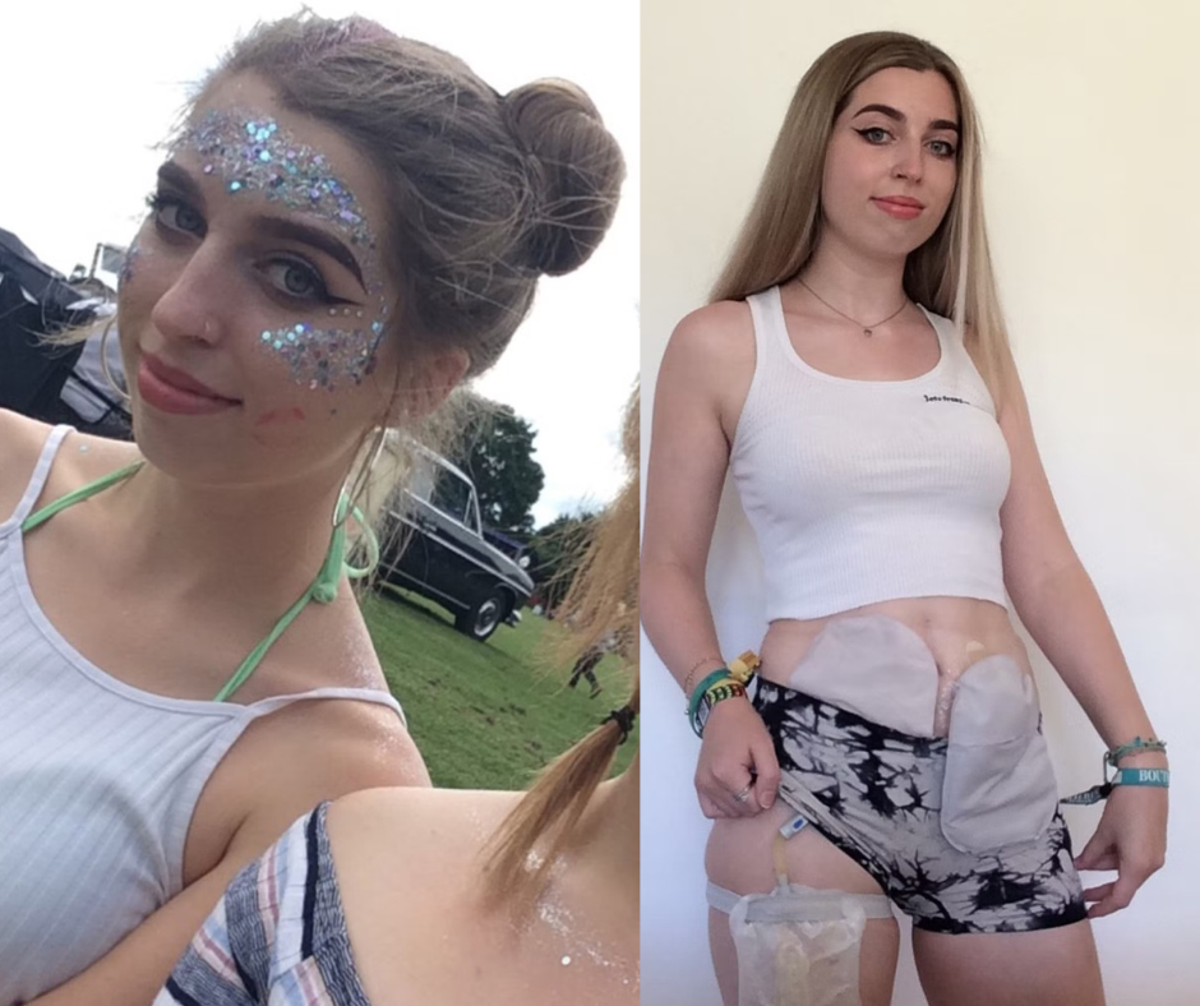 Young woman reveals three bowel cancer symptoms everyone should know