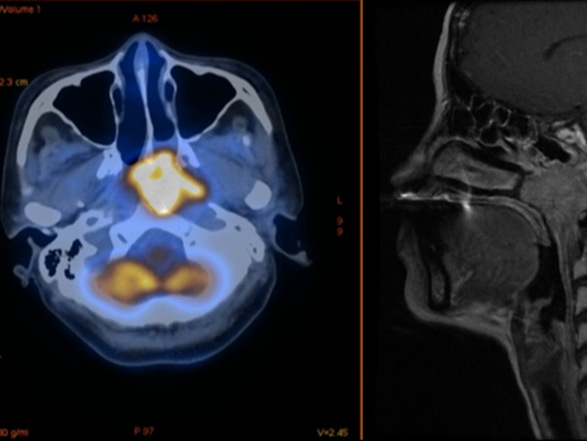 Covid vaccination improves effectiveness of treatment for cancer in nose-throat cavity