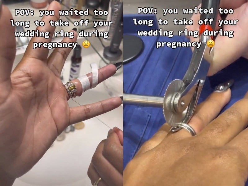 How to Get a Ring swollen finger 3 Easy Steps | BlackTreeLab