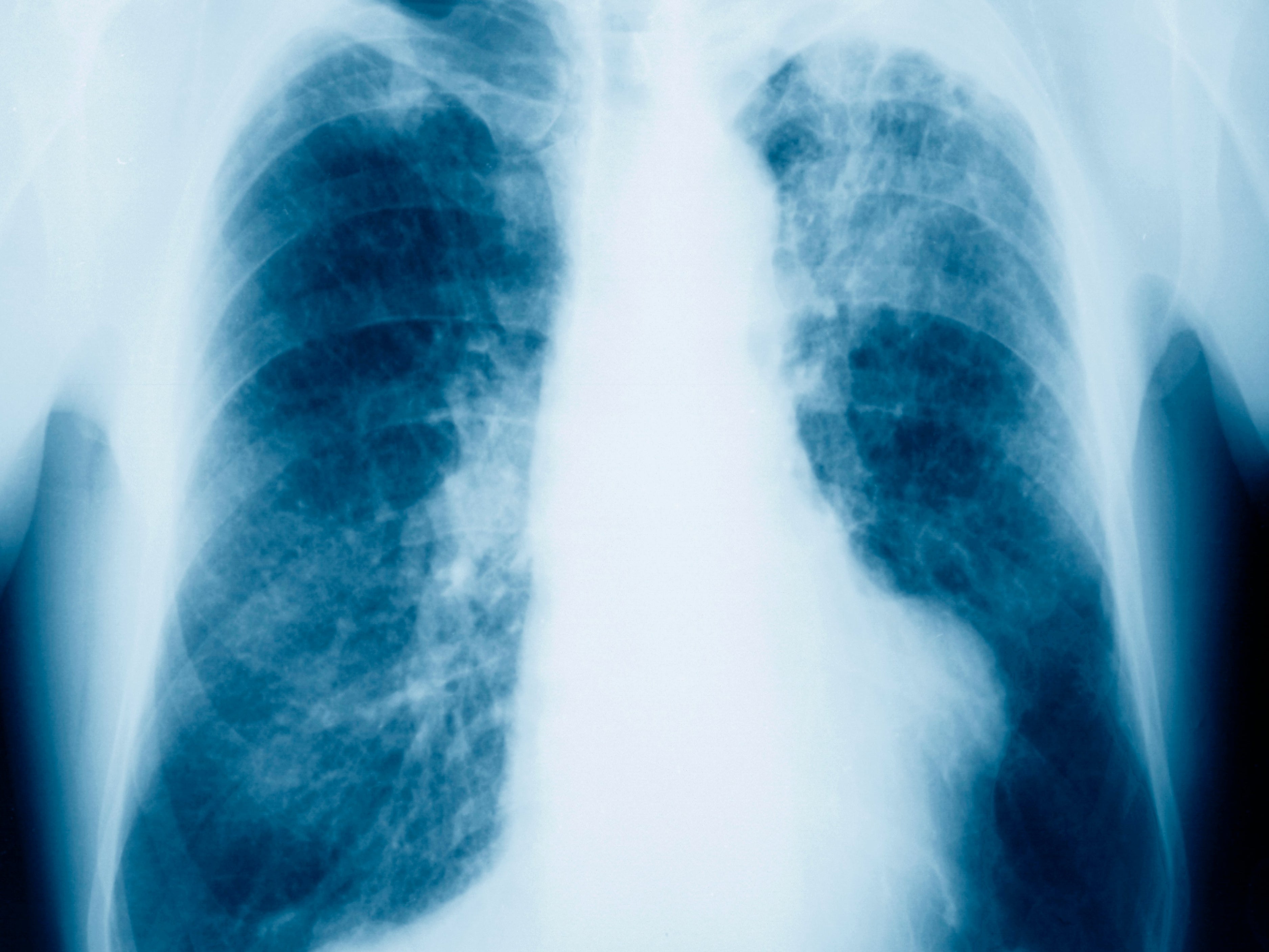 <p>A chest X-ray of a male patient showing evidence of mesothelioma</p>