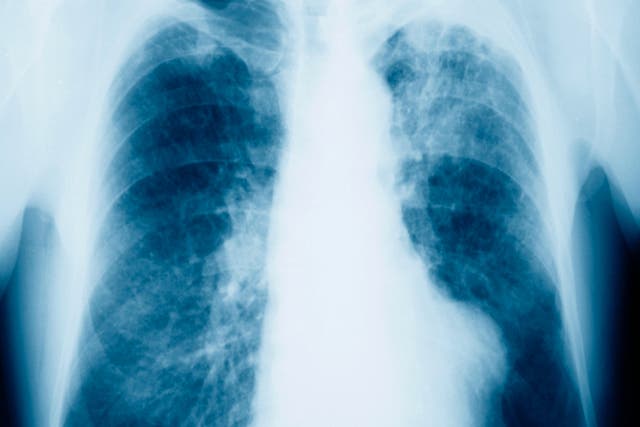 <p>A chest X-ray of a male patient showing evidence of mesothelioma</p>