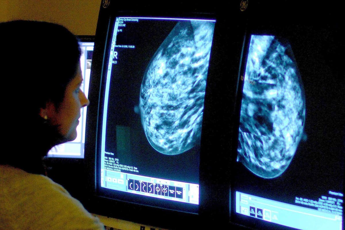 Radiotherapy &lsquo;does not improve breast cancer survival after 30 years&rsquo;