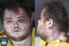 Mugshot shows Colorado Springs suspect Anderson Aldrich with face and neck wounds