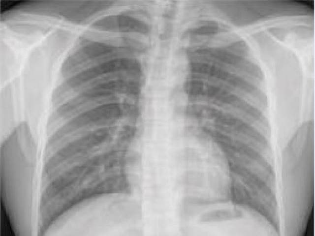 <p>This form of AI can predict the risk of heart disease using simply one chest X-ray, study suggests </p>