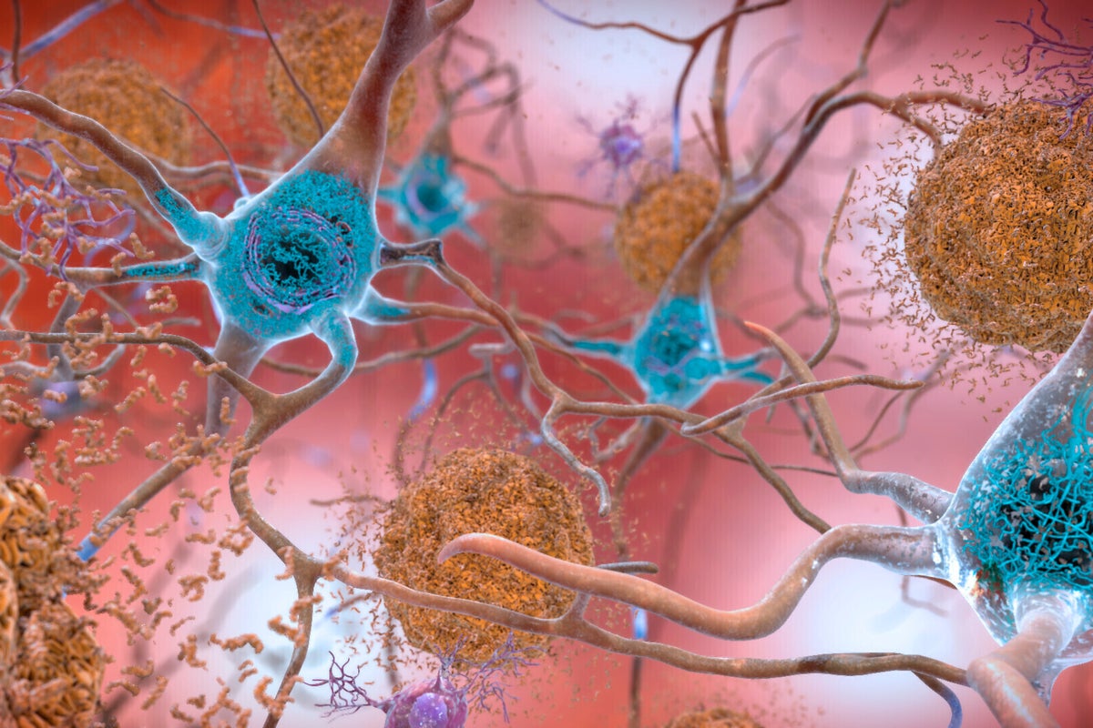 Scientists hail breakthrough as drug proven to slow Alzheimer’s disease