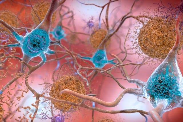 <p>The drug targets protein cells called amyloid which clump together to form harmful plaques associated with Alzheimer’s </p>