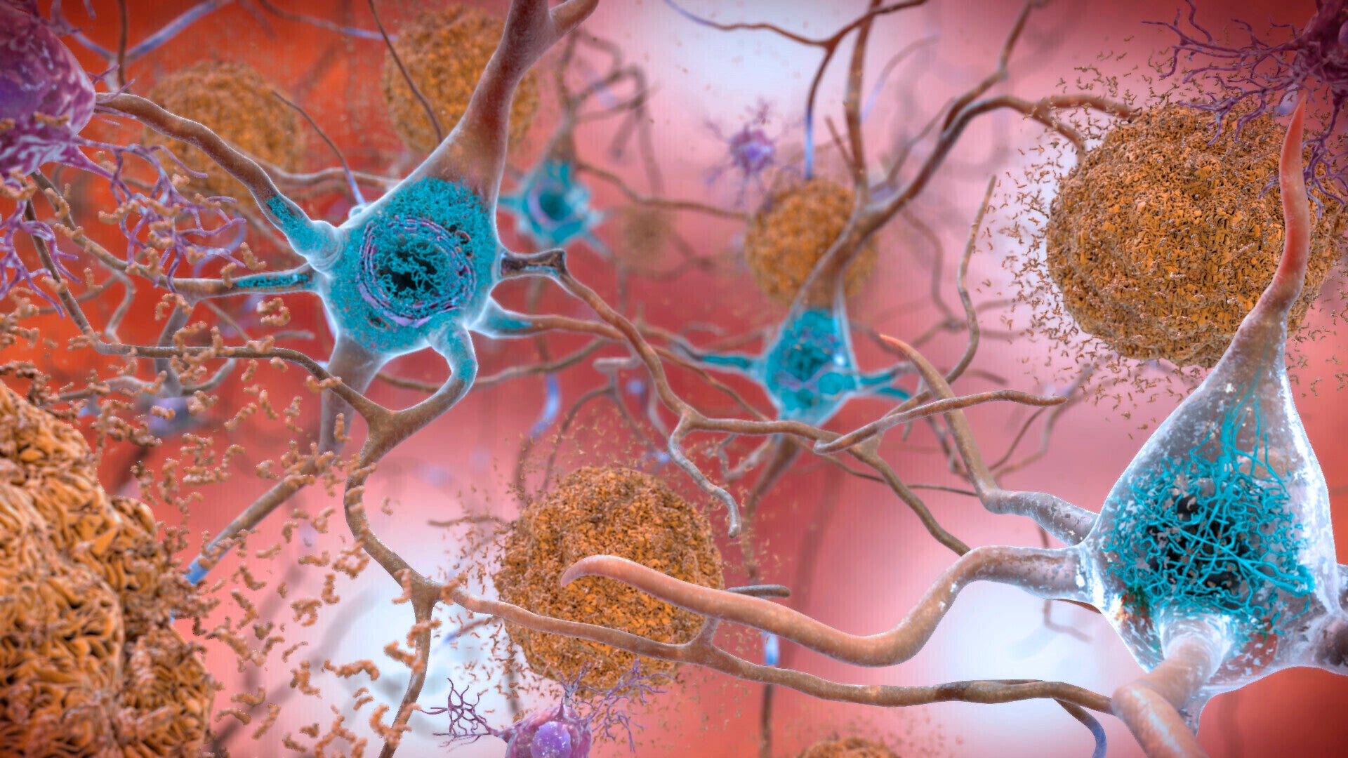 Lecanemab is shown to slow the progression of Alzheimer’s disease