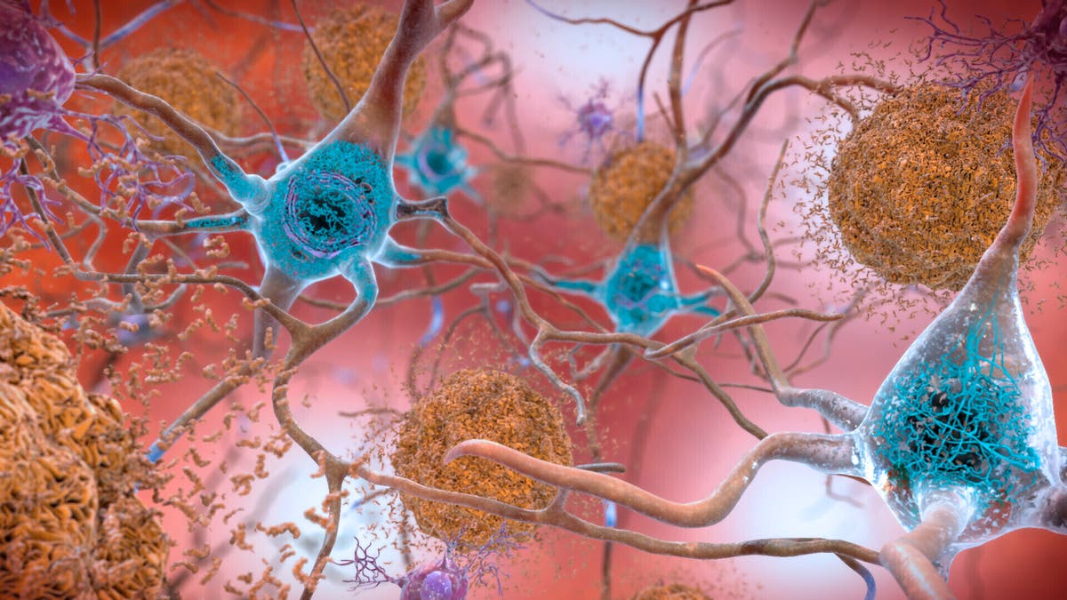 What you need to know about lecanemab – the Alzheimer’s drug rejected for NHS use